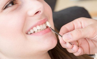 Chipped Teeth
